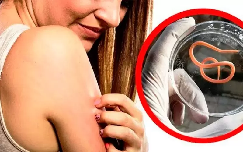 démangeaisons et irritations dues à des parasites dans le corps