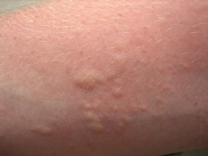 des éruptions cutanées allergiques avec démangeaisons peuvent être des symptômes d'ascaridiose