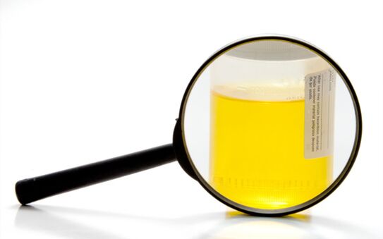 Examen d'urine pour diagnostiquer la schistosomiase