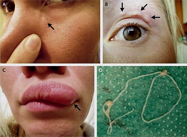 Les principales manifestations de la dirofilariose sur le visage